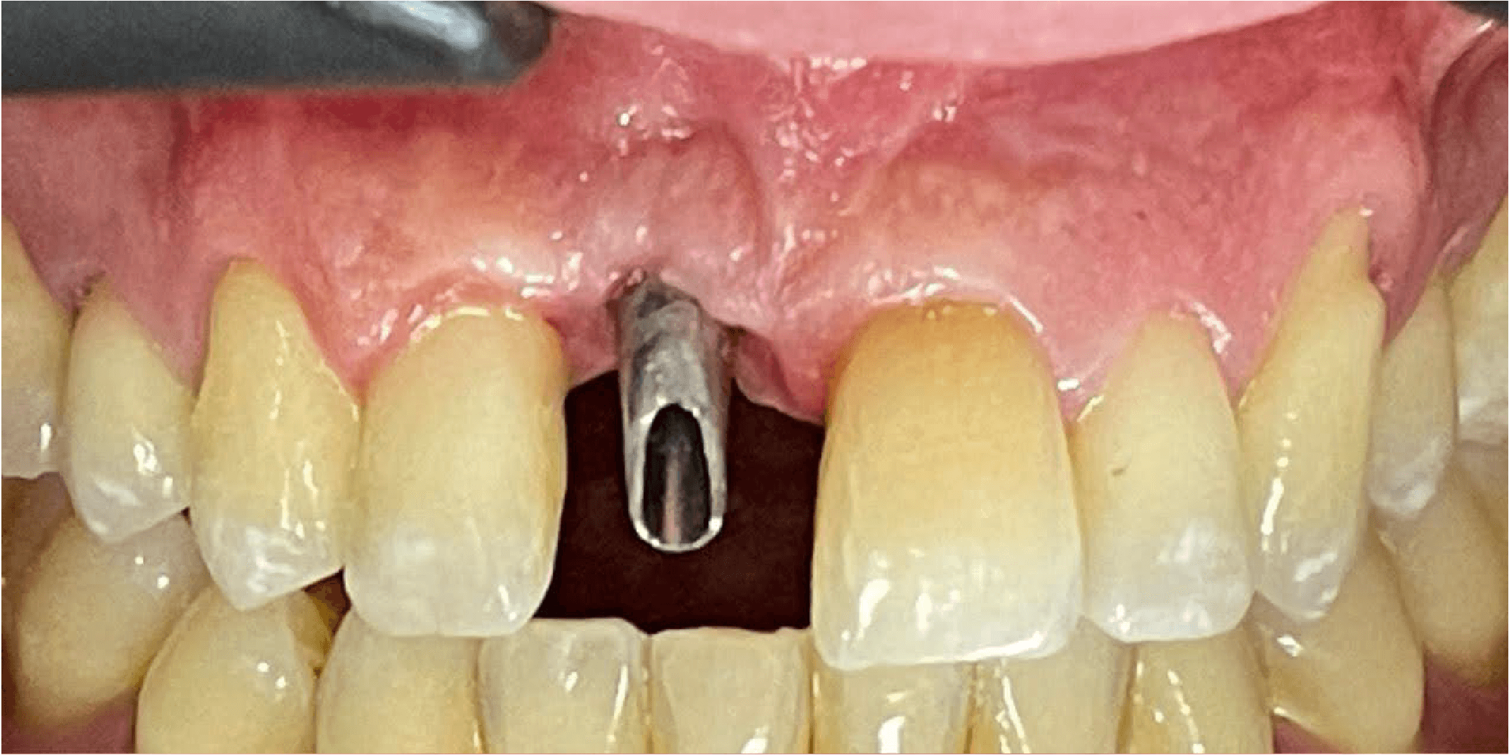 Clinica odontologica especializada en implantes