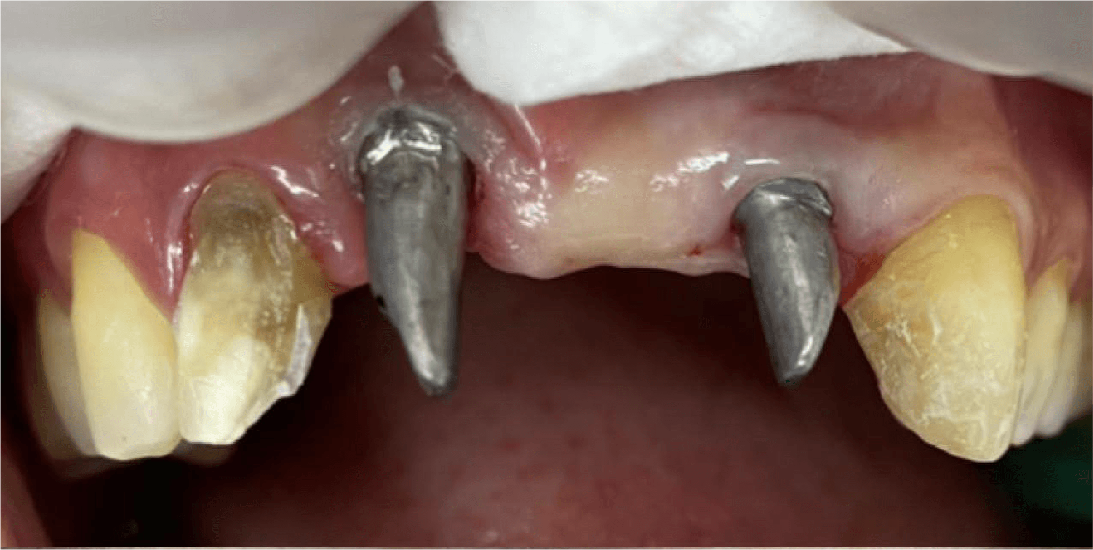 Clinica odontologica especializada en implantes